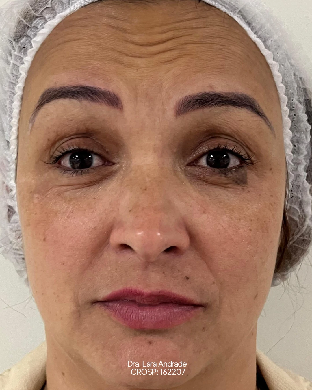 Região tratada antes da aplicação de toxina botulínica
