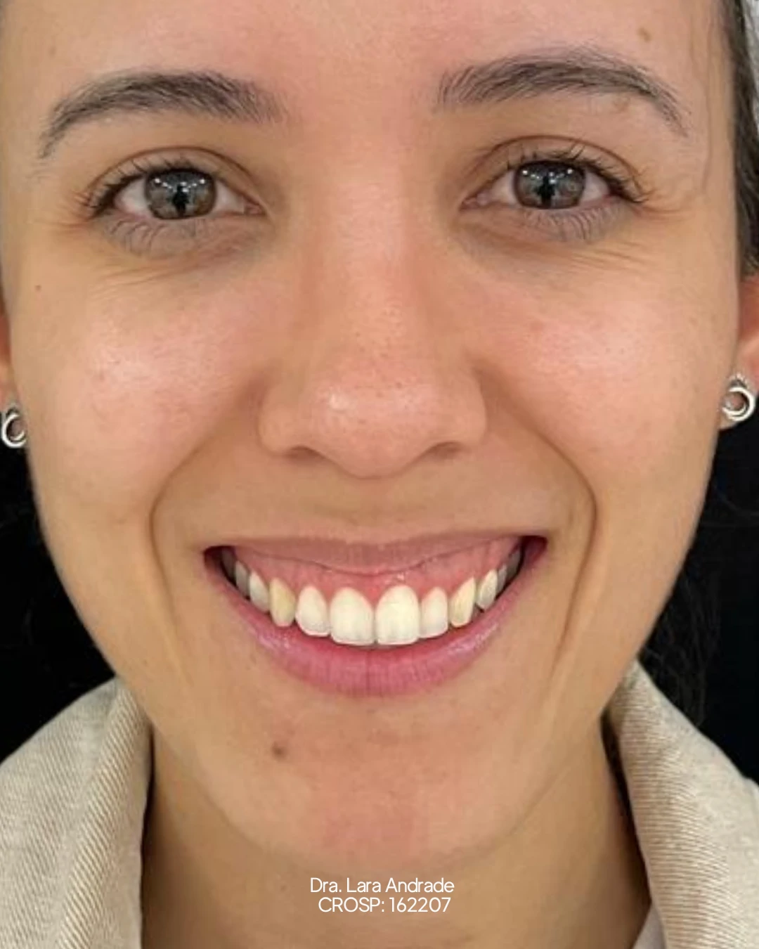 Perfil antes do botox para correção do sorriso gengival realizada pela Dra. Lara Andrade