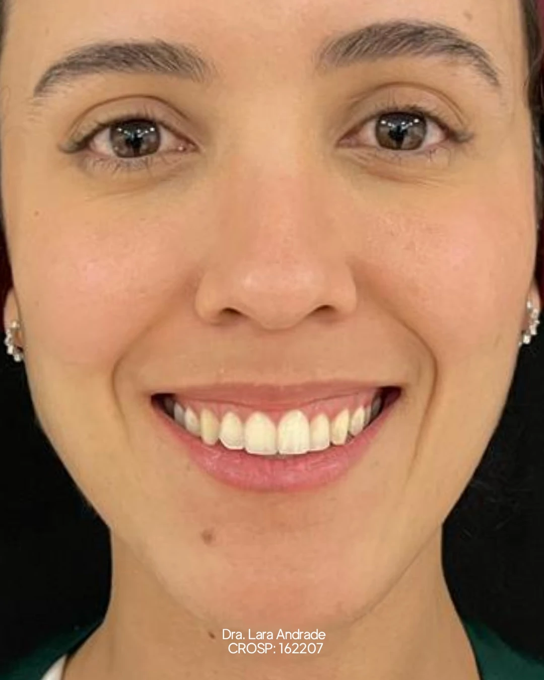 Perfil após a correção do sorriso gengival realizada pela Dra. Lara Andrade