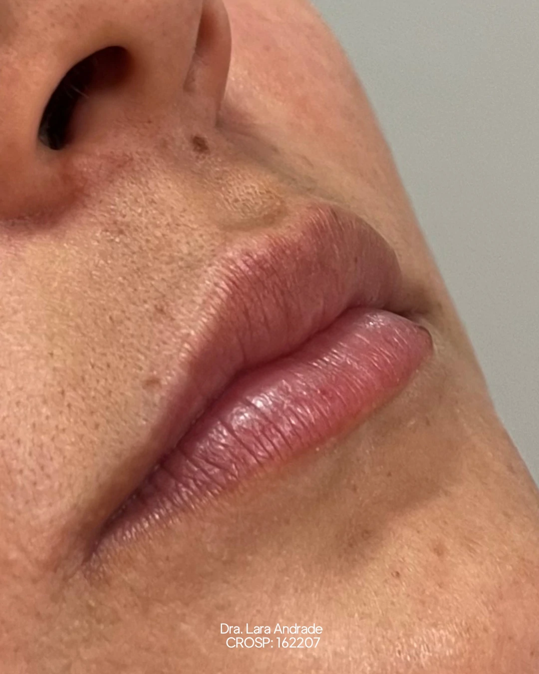 Lábios antes do preenchimento labial realizado pela Dra. Lara Andrade