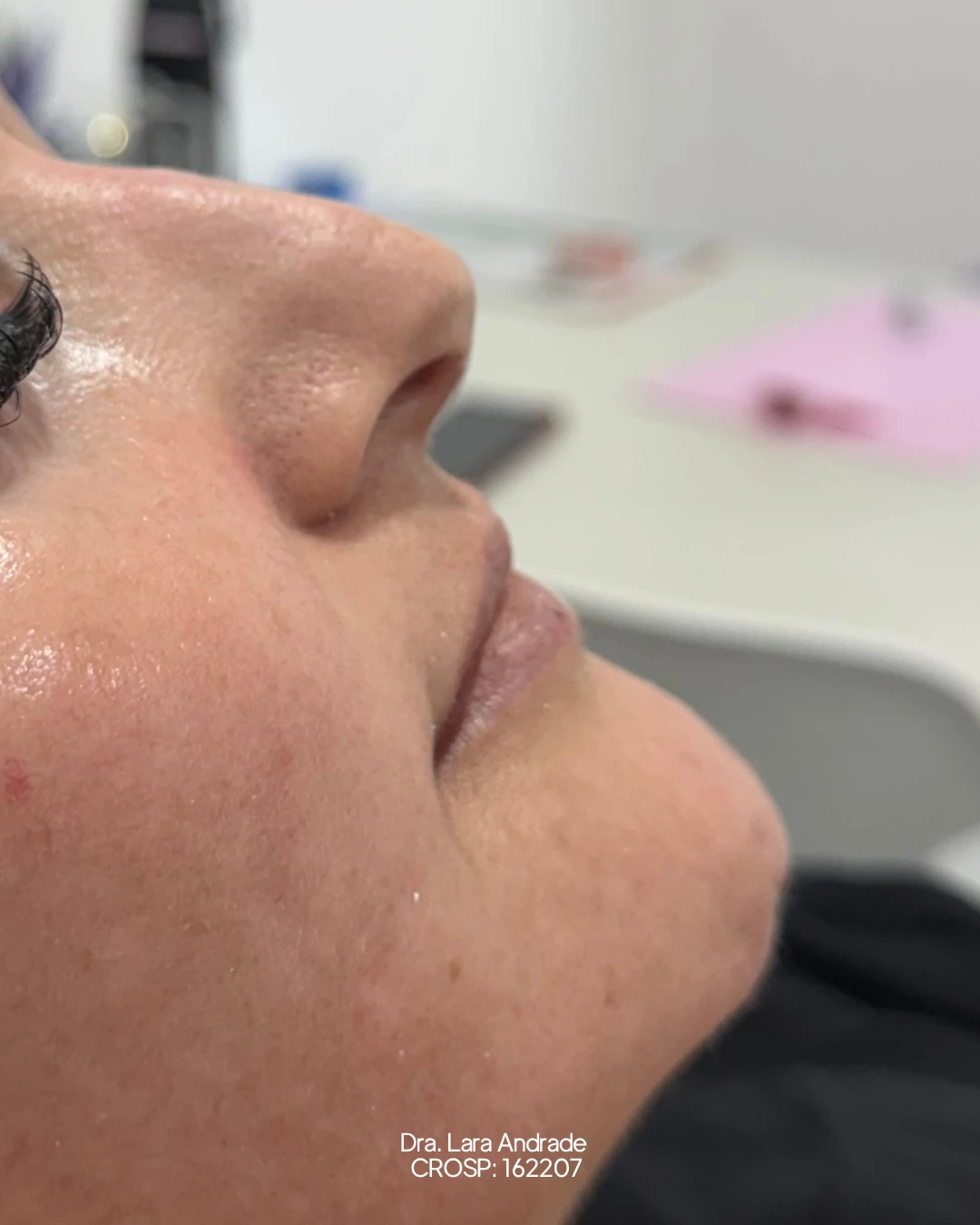 Lábios antes do preenchimento labial realizado pela Dra. Lara Andrade
