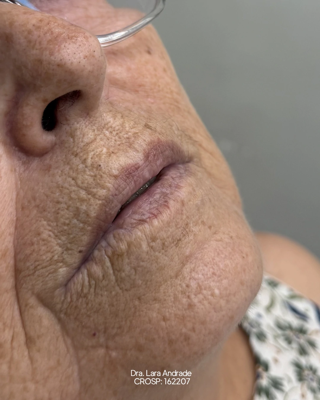 Lábios antes do preenchimento labial realizado pela Dra. Lara Andrade