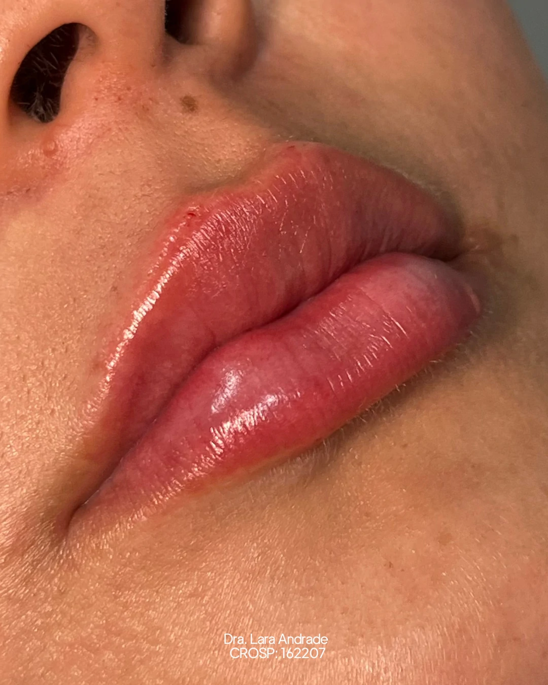Lábios após o preenchimento labial realizado pela Dra. Lara Andrade