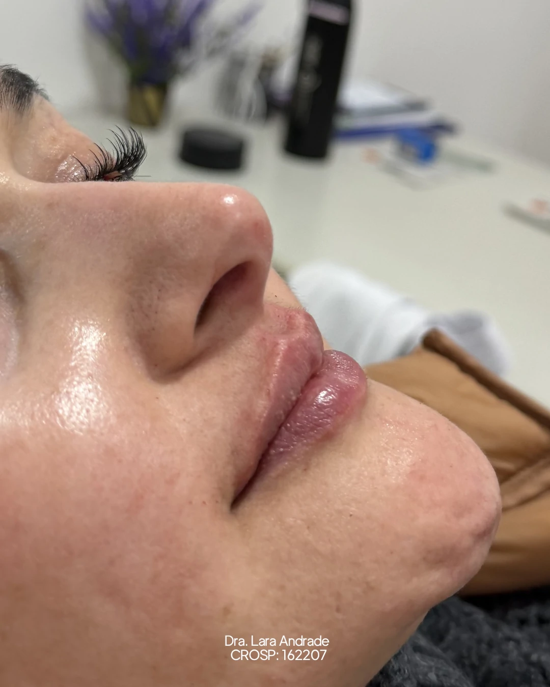 Lábios após o preenchimento labial realizado pela Dra. Lara Andrade