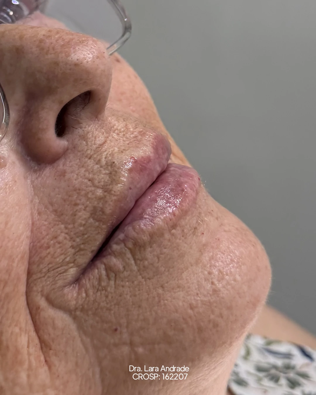 Lábios após o preenchimento labial realizado pela Dra. Lara Andrade
