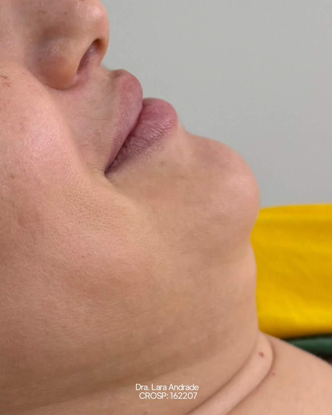 Perfil antes da lipo de papada realizada pela Dra. Lara Andrade