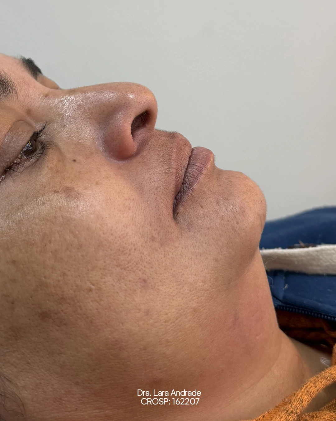 Perfil antes da lipo de papada realizada pela Dra. Lara Andrade