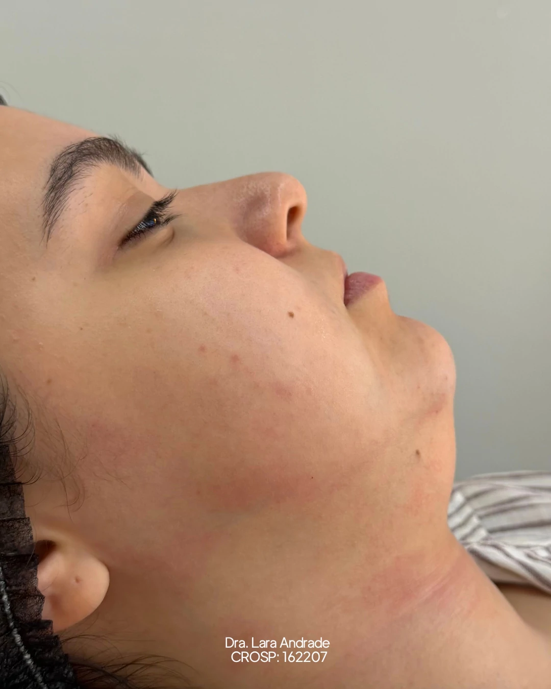 Perfil antes da lipo de papada realizada pela Dra. Lara Andrade