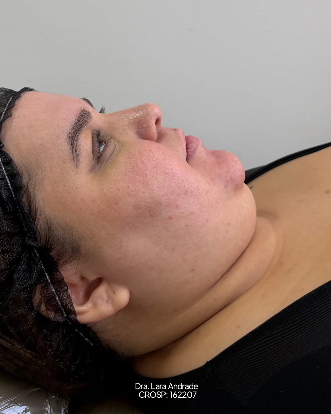 Perfil antes da lipo de papada realizada pela Dra. Lara Andrade