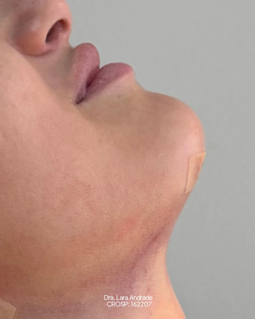 Perfil após a lipo de papada realizada pela Dra. Lara Andrade