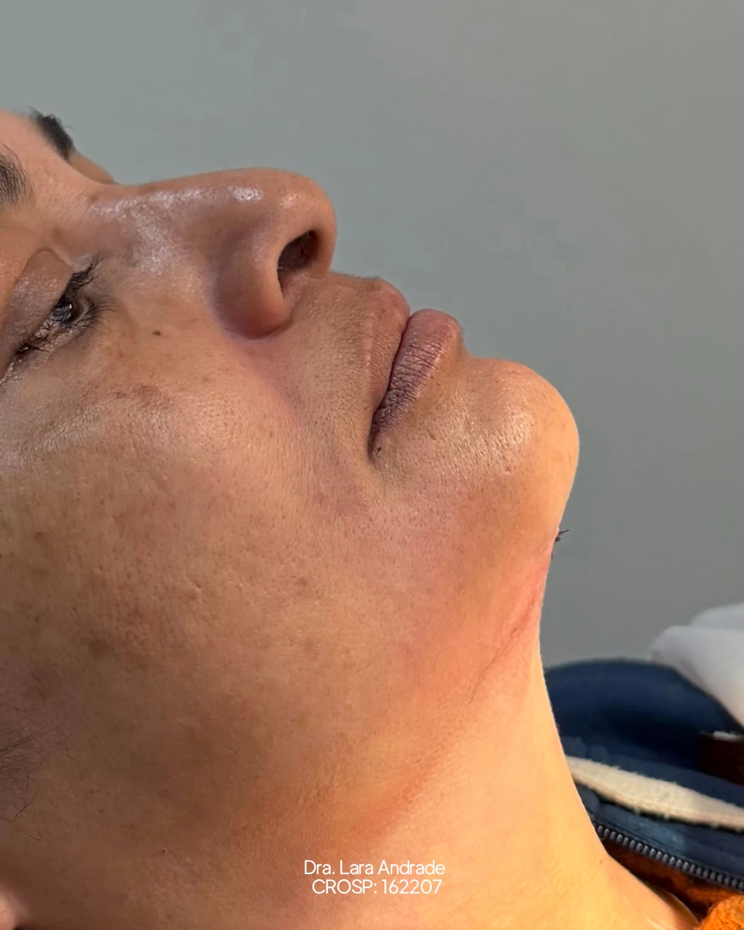 Perfil após a lipo de papada realizada pela Dra. Lara Andrade