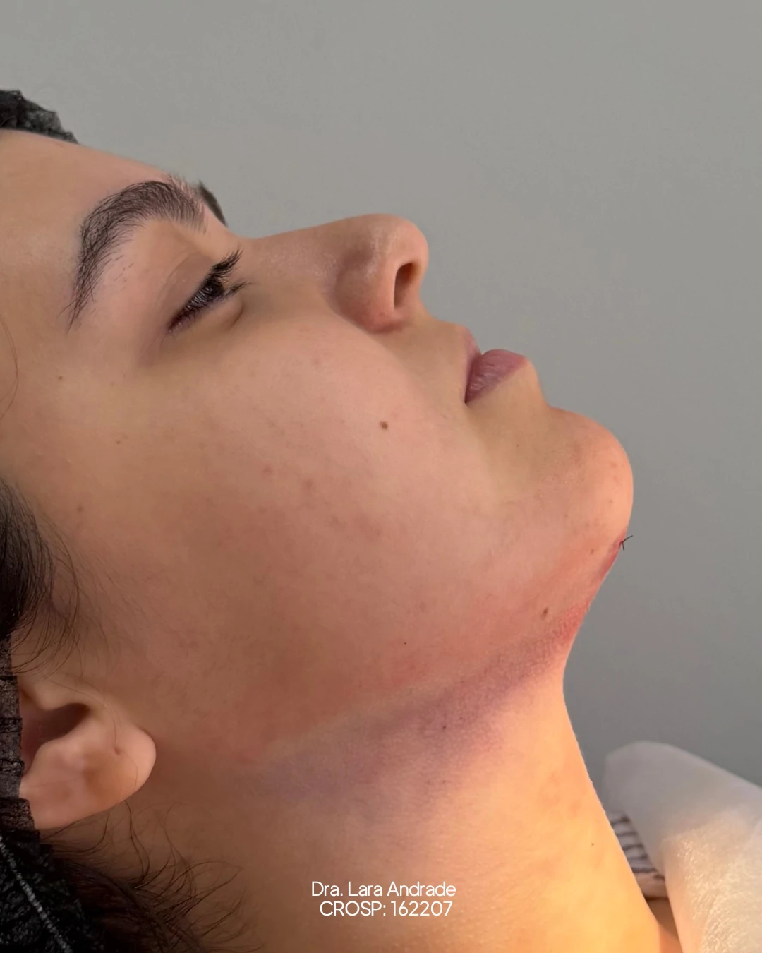 Perfil após a lipo de papada realizada pela Dra. Lara Andrade