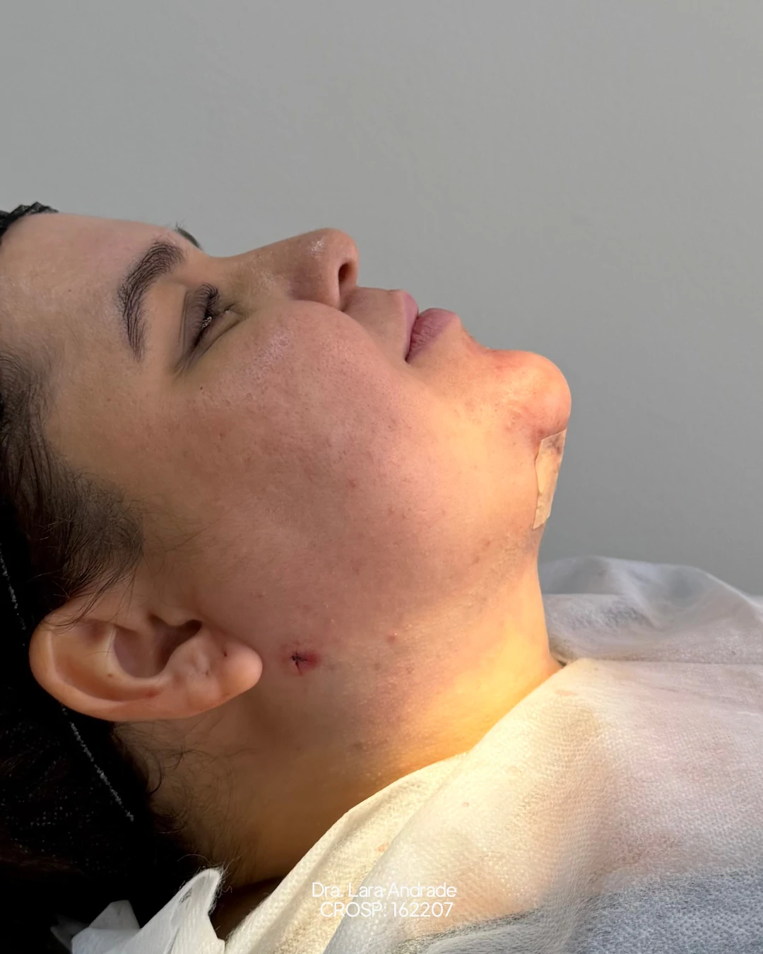 Perfil após a lipo de papada realizada pela Dra. Lara Andrade