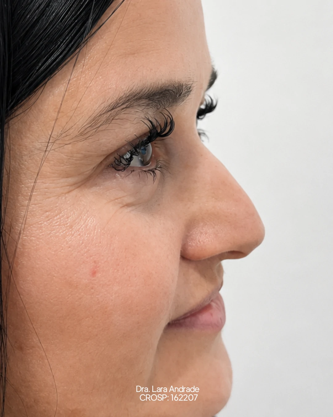 Perfil antes da rinomodelação realizada pela Dra. Lara Andrade